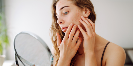 Female with irritated skin in front of mirror vearthy.com
